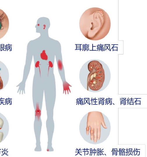 痛风不同阶段，如何选择最有效的治疗方案？